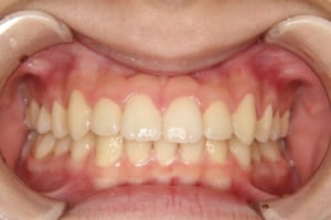 下の前歯が１本先天欠損のため正中は合っていません